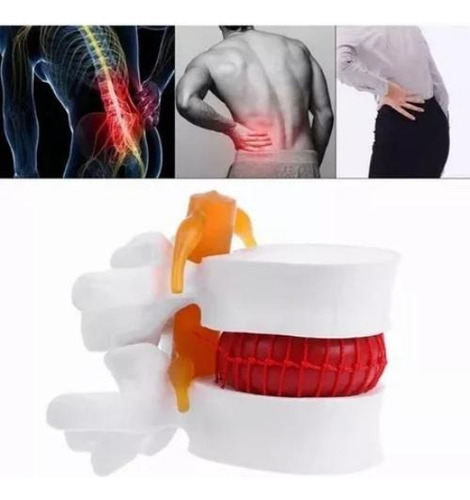 Modelo De Vértebras Lumbares: Columna Anatómica Hernia D