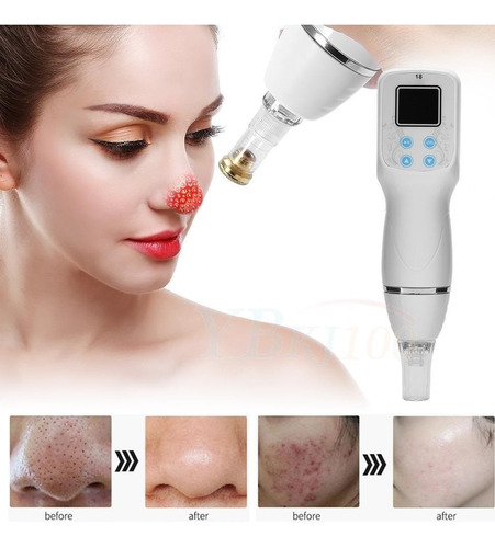 Microdermoabrasion Microdermabrasion Limpiador Facial Poros