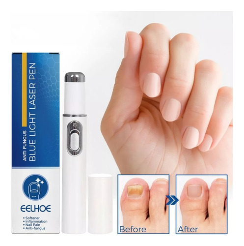 3 Pluma Luz Azul Elimina Hongo Cuidado Uñas Reparación Láser