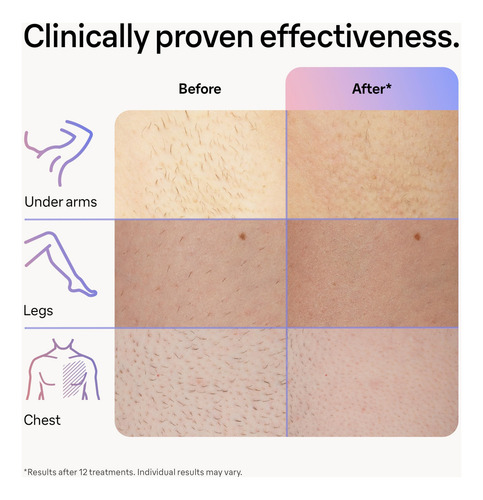 Dispositivo De Depilação A Laser Braun Ipl Skin I·expert Pl7