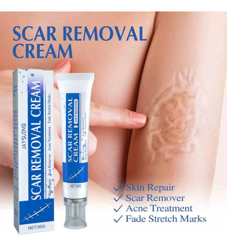 La Crema Para Eliminar Cicatrices Y Eliminar Más Cicatrices