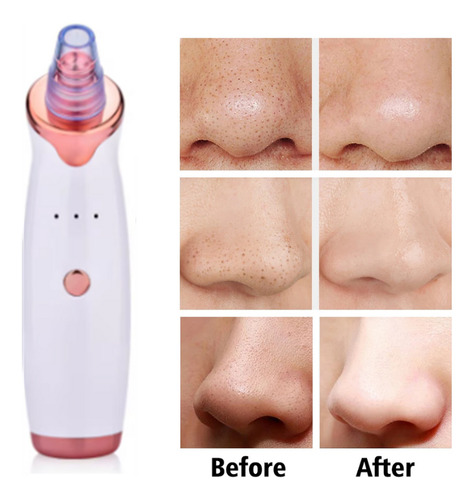 Tratamento Facial Dermoabrasão Led Removedor Cravos, Acne