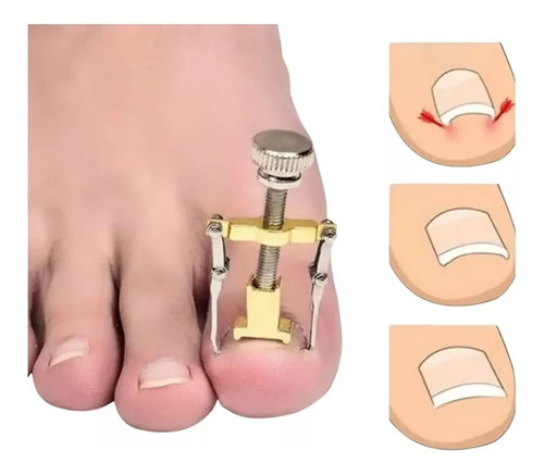 Herramienta Desenterrador Uñas Enterradas Encarnadas Uñeros