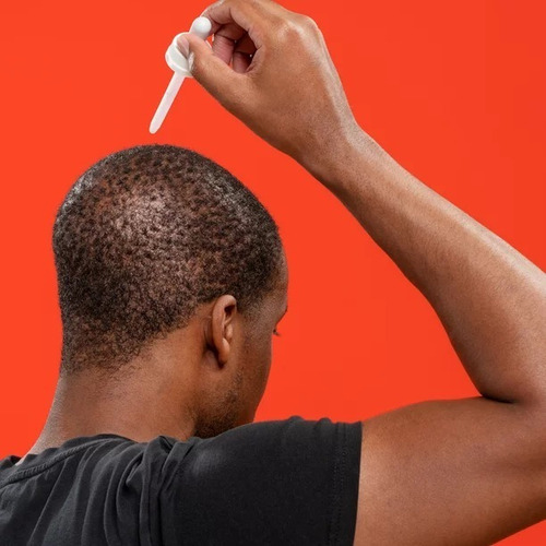 Imagen 2 de 4 de Minoxidil 5% Roman Tópico Extra Fuerza 2 Meses Tratamiento