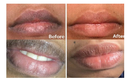Blsamo Exfoliante Para Aclarar Los Labios, Elimina Los Labio