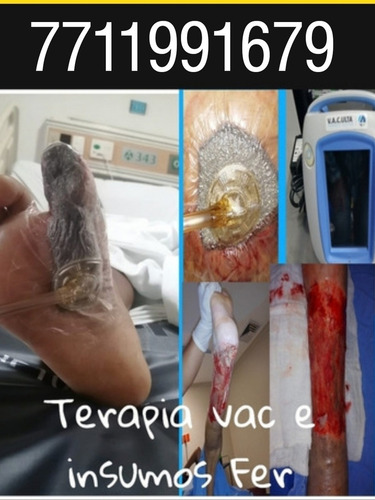 Imagen 1 de 5 de Terapia Vac Tratamiento Curación De Heridas Venta Insumos