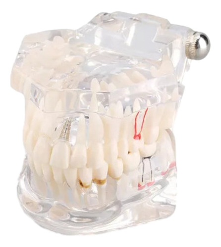 Modelo De Dientes Para Estudio De Enfermedades Dentales Remo