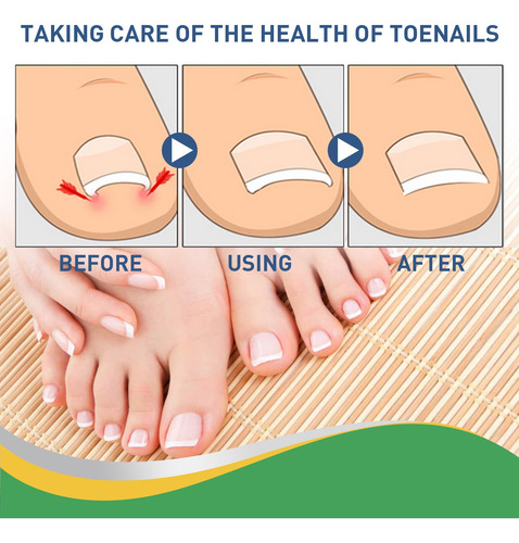 Pegatina Para Uñas Encarnadas En Forma De W Con Herramienta