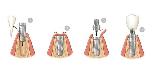 Imagen 3 de 3 de Implante Dental Straumann Con Corona De Porcelana. Belgrano