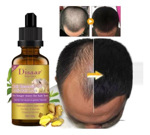 Aceite Alopecia Calvicie Anticaída De Cabello , Anti Perdida