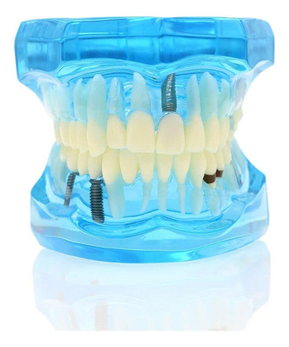 Modelo De Dientes Dentales Implante Typodont Modelo Enseñar