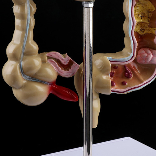 Para Para Modelo De Intestino Grueso Con Lesión De Colon