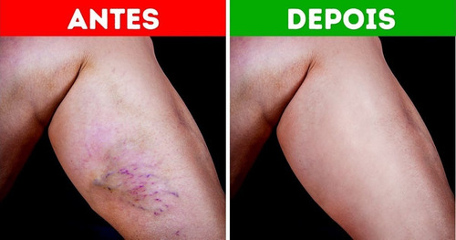 Imagem 1 de 3 de Varizer Remover