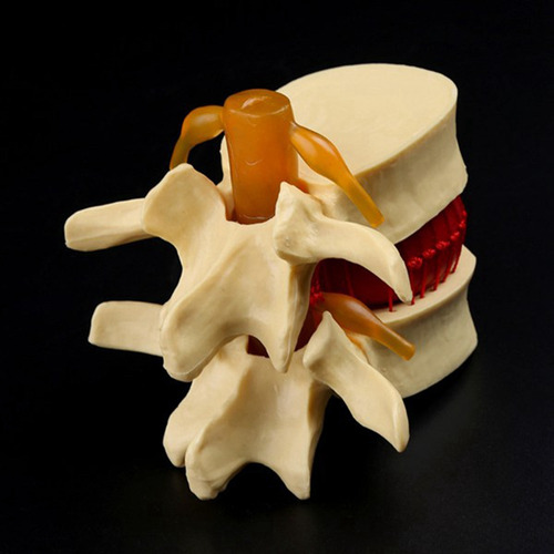 Modelo De Vértebras Lumbares: Columna Anatómica Hernia D