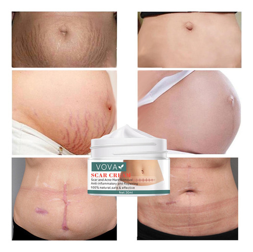. Crema For Quitar Cicatrices Y Reparar La Piel, 2 Unidades,