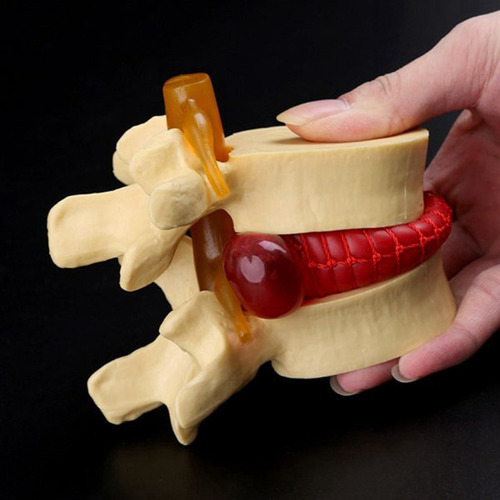 Modelo Anatomico Disco Lombar Coluna Vertebral Humana Hernia
