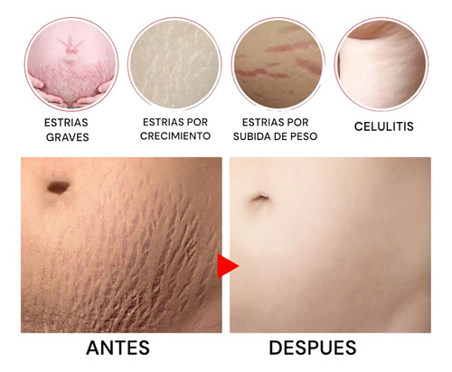 Tratamiento Profesional Permanente Para Eliminar Estrías Neutra
