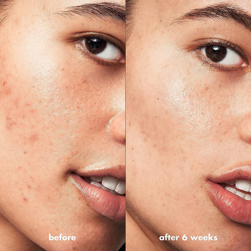 Elf Blemish Breakthrough Kit Control De Acne Imperfecciones
