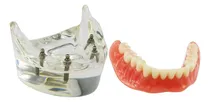 Comprar Modelo De Implante Dental Con Sobredentadura Inferior M6003