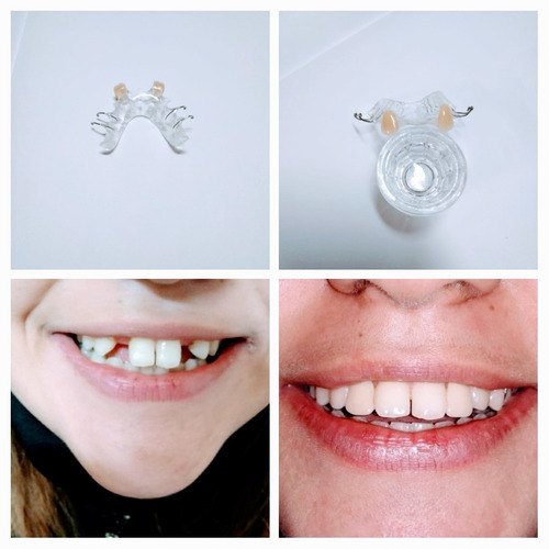 Imagen 4 de 5 de Prótesis Dentales - Dentista - Placas Contencion Y Bruxismo