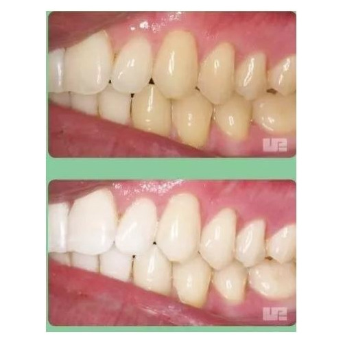 Blanqueamiento Dental 15% Opalescence