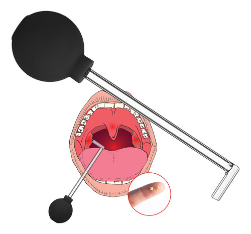 Trelaco Herramienta De Extraccion De Piedra De Amigdala, Tub