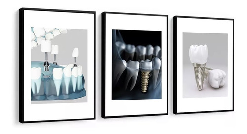 Quadros Decorativos Odontologia Implante Dentista Luxo 60x80