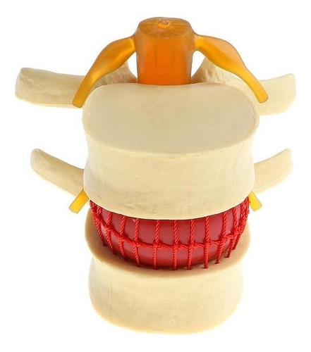 . 2x Modelo De Hernia De Disco Lumbar De La Columna