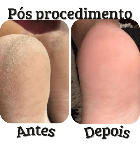 Kit Cora Spa Dos Pés E Calosidade Com Botinha E Espátula 222