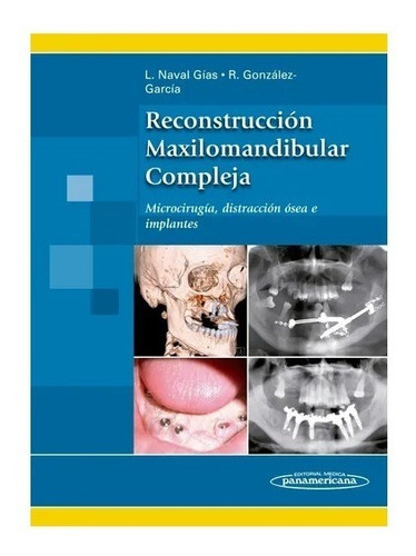 Reconstrucción Maxilomandibular Compleja
