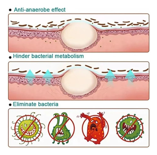 Crema Para Psoriasis, Crema Anti Picazón. Nuevas Tecnologías