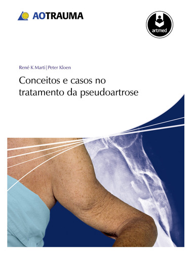 Conceitos e Casos no Tratamento da Pseudoartrose, de Marti, René K.. Editorial Artmed Editora Ltda., capa dura em português, 2013