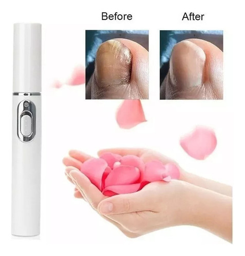 Lápiz Láser Para Hongos En Uñas, 2 Bolígrafos, Luz Azul