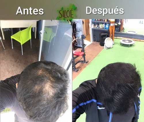 Pack De 3 Shampoos Siloe Contra Calvicie, Caspa, Alopecia.