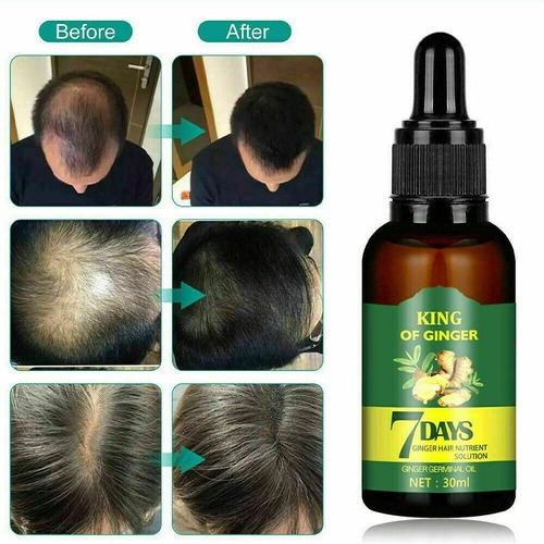 3pcs 30ml Soro Essência Capilar Crescimento Calvície Cabelo