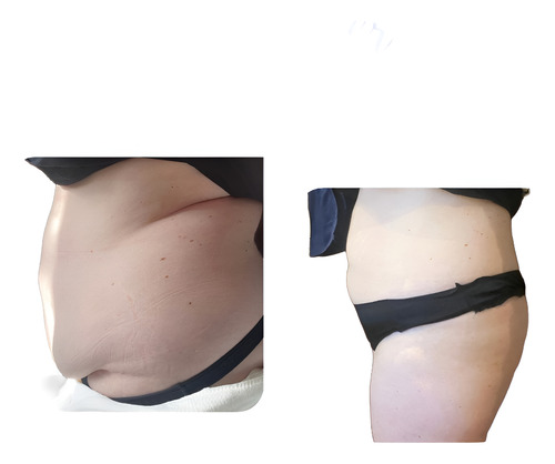 Sesiones Lipolaser Corporal - Promoción Especial