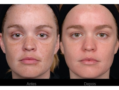 Serum Ac. Hialuronico E Retinol Clareador Manchas