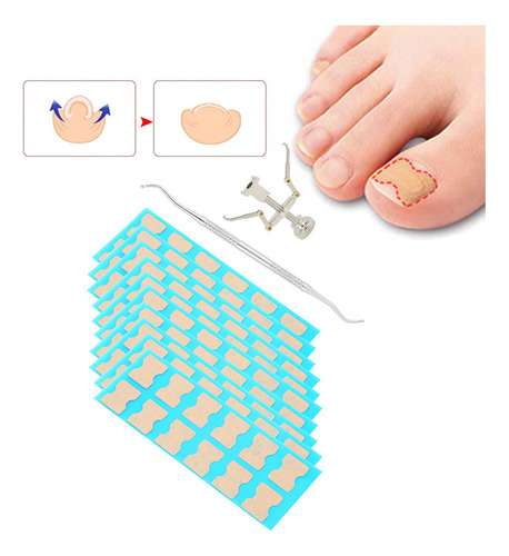 Parche De Corrección De Uñas Encarnadas Corrector De Uñas En