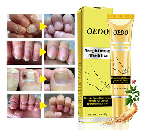 Crema Para Hongos En Las Uñas, Cuidado De Los Pies, Antimicó