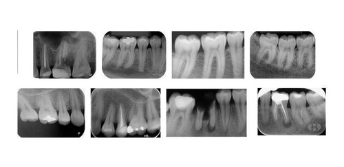 Radiografia Periapical Odontologia
