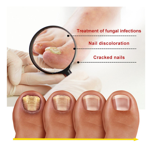 7×reparación La Decoloración Las Uñas Onicomicosis Soft