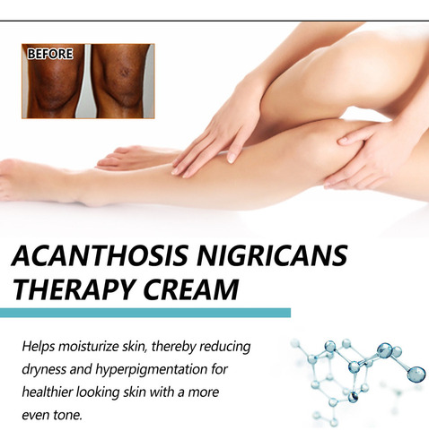 4×fixderma Nigrifix Crema Para Acantosis Nigricans Fbg E