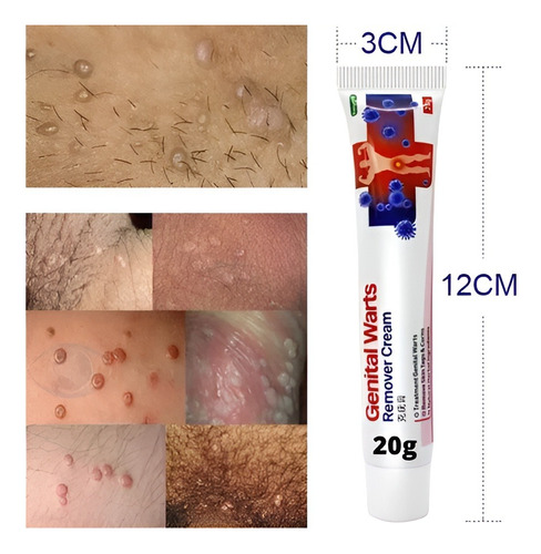 1x Pomada Contra Verruga Partes Íntimas | Hpv | Coceira