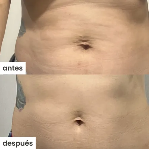 Ventosa celulitis antes y después clearance