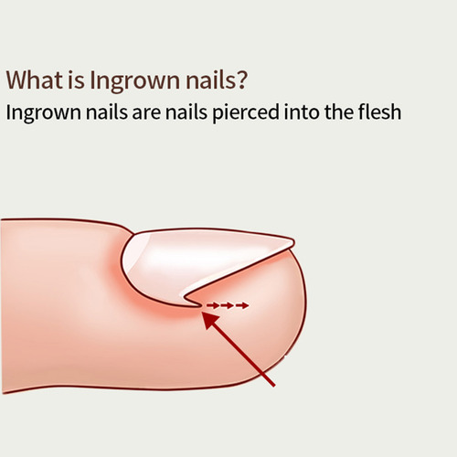 Herramienta Para Pedicura De Uñas De Los Pies 12 Delineador