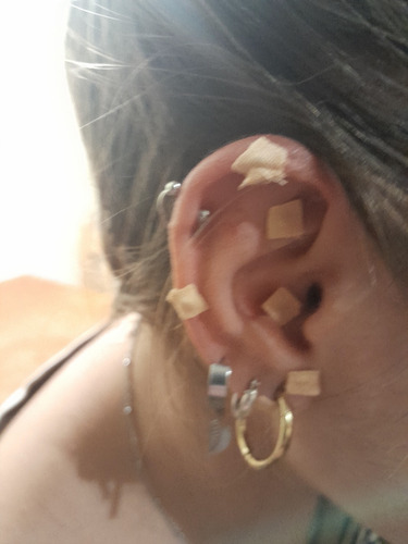 Auriculoterapia