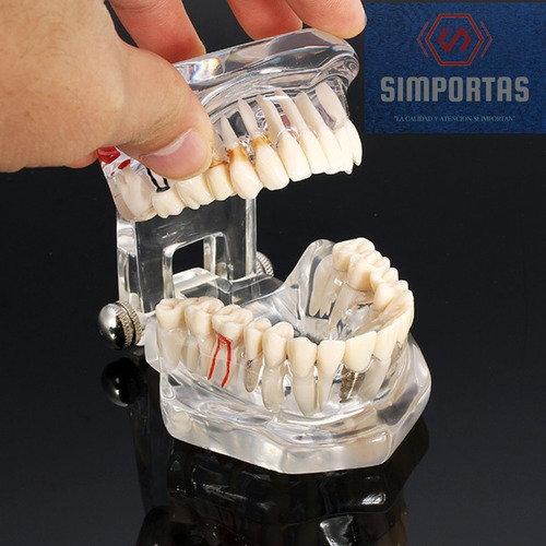 Imagen 1 de 5 de Modelo Dental Enseñanza Y Tratamientos Implantes Protesis
