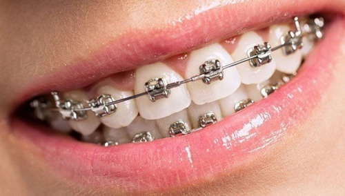 Ortodoncia, Brackets Metálicos Y Estéticos