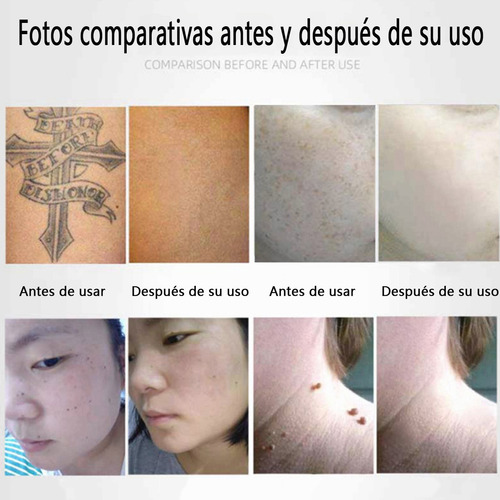 Laser Picosecond Para Tatuajes Manchas Lunares Inalámbrico