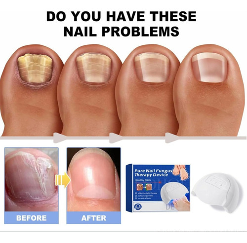 Dispositivo De Terapia Láser Para Hongos En Las Uñas